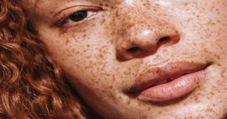 Home Remedies for freckles । 9 Best ways । LovHind