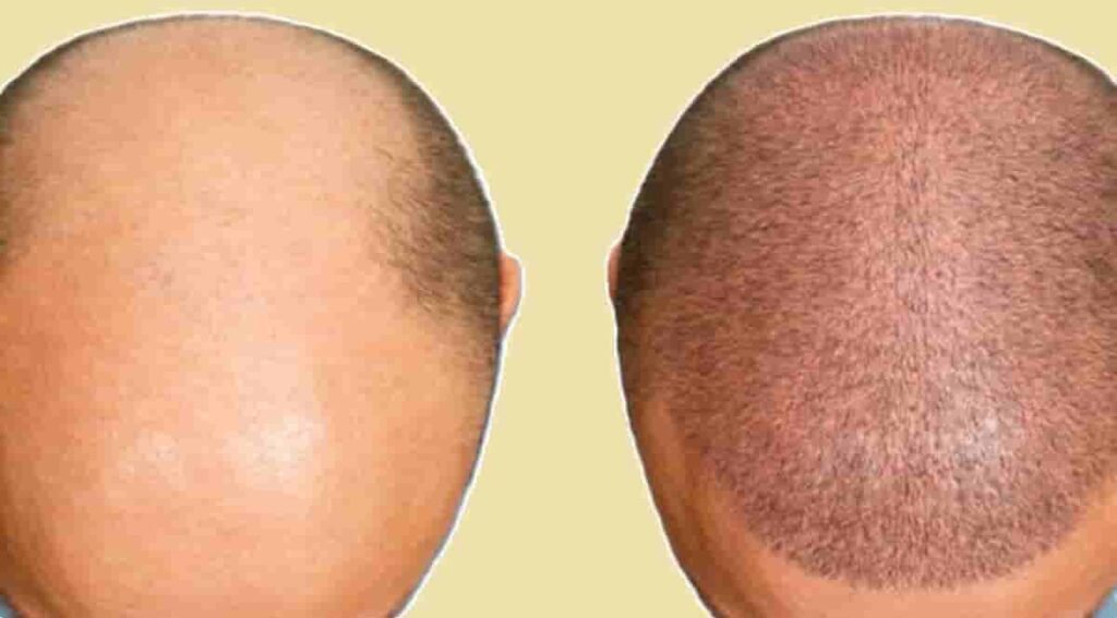 Hair Transplants: Costs, Techniques, and FAQs